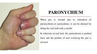PARONYCHIUM
When pus is formed due to formation of
paronychium or eponychium, it can be drained by
lifting the nail fold with a needle.
In infection of nail bed, the eponychium is pushed
back and the portion of nail overlying the pus is
excised.
 