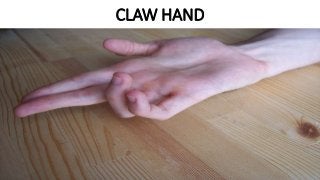 CLAW HAND
 