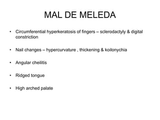 MAL DE MELEDA
• Circumferential hyperkeratosis of fingers – sclerodactyly & digital
constriction
• Nail changes – hypercurvature , thickening & koilonychia
• Angular cheilitis
• Ridged tongue
• High arched palate
 