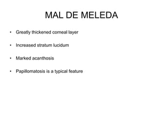 MAL DE MELEDA
• Greatly thickened corneal layer
• Increased stratum lucidum
• Marked acanthosis
• Papillomatosis is a typical feature
 