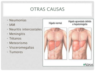OTRAS CAUSAS
•
•
•
•
•
•
•
•

Neumonías
IAM
Neuritis intercostales
Meningitis
Tétanos
Meteorismo
Visceromegalias
Tumores

 