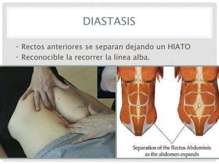 DIASTASIS
• Rectos anteriores se separan dejando un HIATO
• Reconocible la recorrer la línea alba.

 