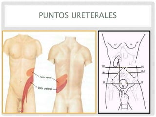 PUNTOS URETERALES

 