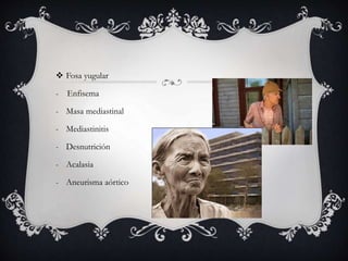  Fosa yugular
- Enfisema
- Masa mediastinal
- Mediastinitis
- Desnutrición
- Acalasia
- Aneurisma aórtico
 