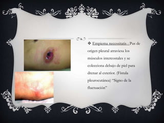  Empiema necessitatis : Pus de
origen pleural atraviesa los
músculos intercostales y se
colecciona debajo de piel para
drenar al exterior. (Fístula
pleurocutánea) “Signo de la
fluctuación”
 