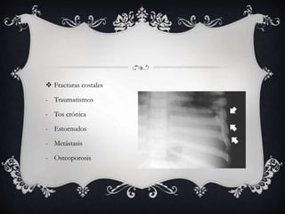  Fracturas costales
- Traumatismos
- Tos crónica
- Estornudos
- Metástasis
- Osteoporosis
 