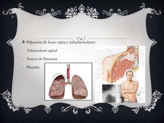 Palpación de fosas supra e infraclaviculares:
- Tuberculosis apical
- Tumor de Pancoast
- Pleuritis
 