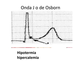Onda J o de Osborn




Hipotermia
hipercalemia
 