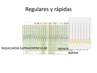 Regulares y rápidas




TAQUICARDIA SUPRAVENTRICULAR   REENTRADA NODAL AV
                                     RÁPIDA
 