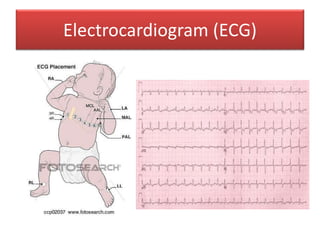 Electrocardiogram (ECG)
 