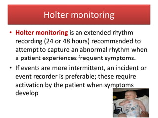 Holter monitoring
• Holter monitoring is an extended rhythm
recording (24 or 48 hours) recommended to
attempt to capture an abnormal rhythm when
a patient experiences frequent symptoms.
• If events are more intermittent, an incident or
event recorder is preferable; these require
activation by the patient when symptoms
develop.
 
