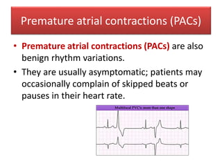 Premature atrial contractions (PACs)
• Premature atrial contractions (PACs) are also
benign rhythm variations.
• They are usually asymptomatic; patients may
occasionally complain of skipped beats or
pauses in their heart rate.
 
