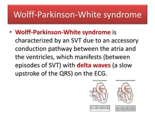Wolff-Parkinson-White syndrome
• Wolff-Parkinson-White syndrome is
characterized by an SVT due to an accessory
conduction pathway between the atria and
the ventricles, which manifests (between
episodes of SVT) with delta waves (a slow
upstroke of the QRS) on the ECG.
 
