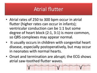 Atrial flutter
• Atrial rates of 250 to 300 bpm occur in atrial
flutter (higher rates can occur in infants);
ventricular conduction can be 1:1 but some
degree of heart block (2:1, 3:1) is more common,
so QRS complexes may appear normal.
• It usually occurs in children with congenital heart
disease, especially postoperatively, but may occur
in neonates with normal hearts.
• Onset and termination are abrupt; the ECG shows
atrial saw-toothed flutter waves.
 