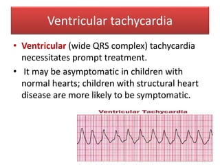 Ventricular tachycardia
• Ventricular (wide QRS complex) tachycardia
necessitates prompt treatment.
• It may be asymptomatic in children with
normal hearts; children with structural heart
disease are more likely to be symptomatic.
 