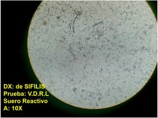 DX: de SIFILIS
Prueba: V.D.R.L
Suero Reactivo
A: 10X

 