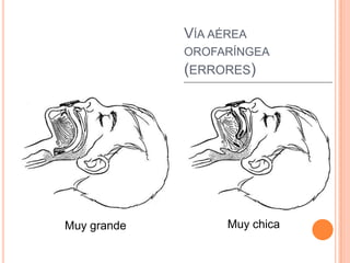 VÍA AÉREA
OROFARÍNGEA
(ERRORES)
Muy grande Muy chica
 