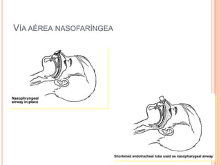 VÍA AÉREA NASOFARÍNGEA
 