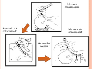 Introducir
laringoscopio
Avanzarlo e ir
retrocediendo
Introducir tubo
endotraqueal
Ver cuerdas
vocales
 