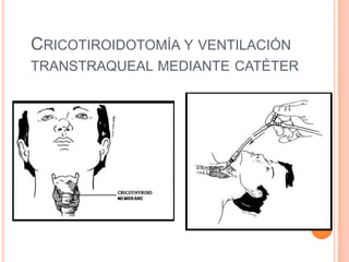 CRICOTIROIDOTOMÍA Y VENTILACIÓN
TRANSTRAQUEAL MEDIANTE CATÉTER
 