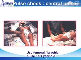 16
Pulse check : central pulse
Use femoral / brachial
pulse : < 1 year-old
 
