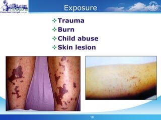 18
Exposure
Trauma
Burn
Child abuse
Skin lesion
 