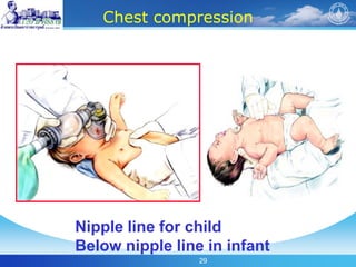 29
Chest compression
Nipple line for child
Below nipple line in infant
 
