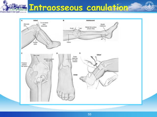 55
Intraosseous canulation
 