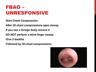 FBAO –
UNRESPONSIVE
Start Chest Compression
After 30 chest compressions open airway
If you see a foreign body remove it
DO NOT perform a blind finger sweep
Give 2 breaths
Followed by 30 chest compressions
 