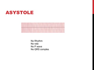 ASYSTOLE
 
  
No Rhythm
No rate
No P wave
No QRS comples
 