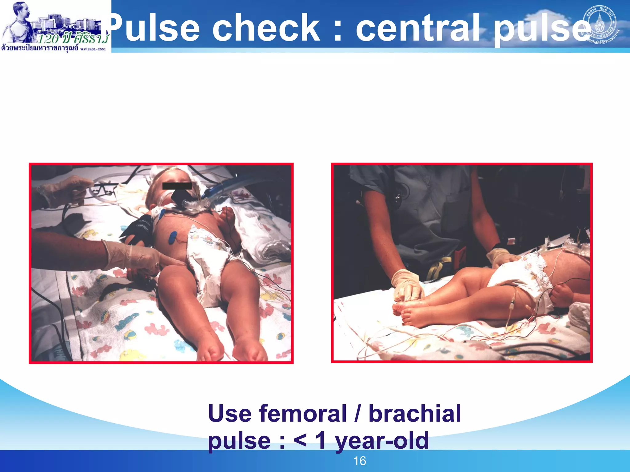 Pulse check : central pulse




     Use femoral / brachial
     pulse : < 1 year-old
                 16
 