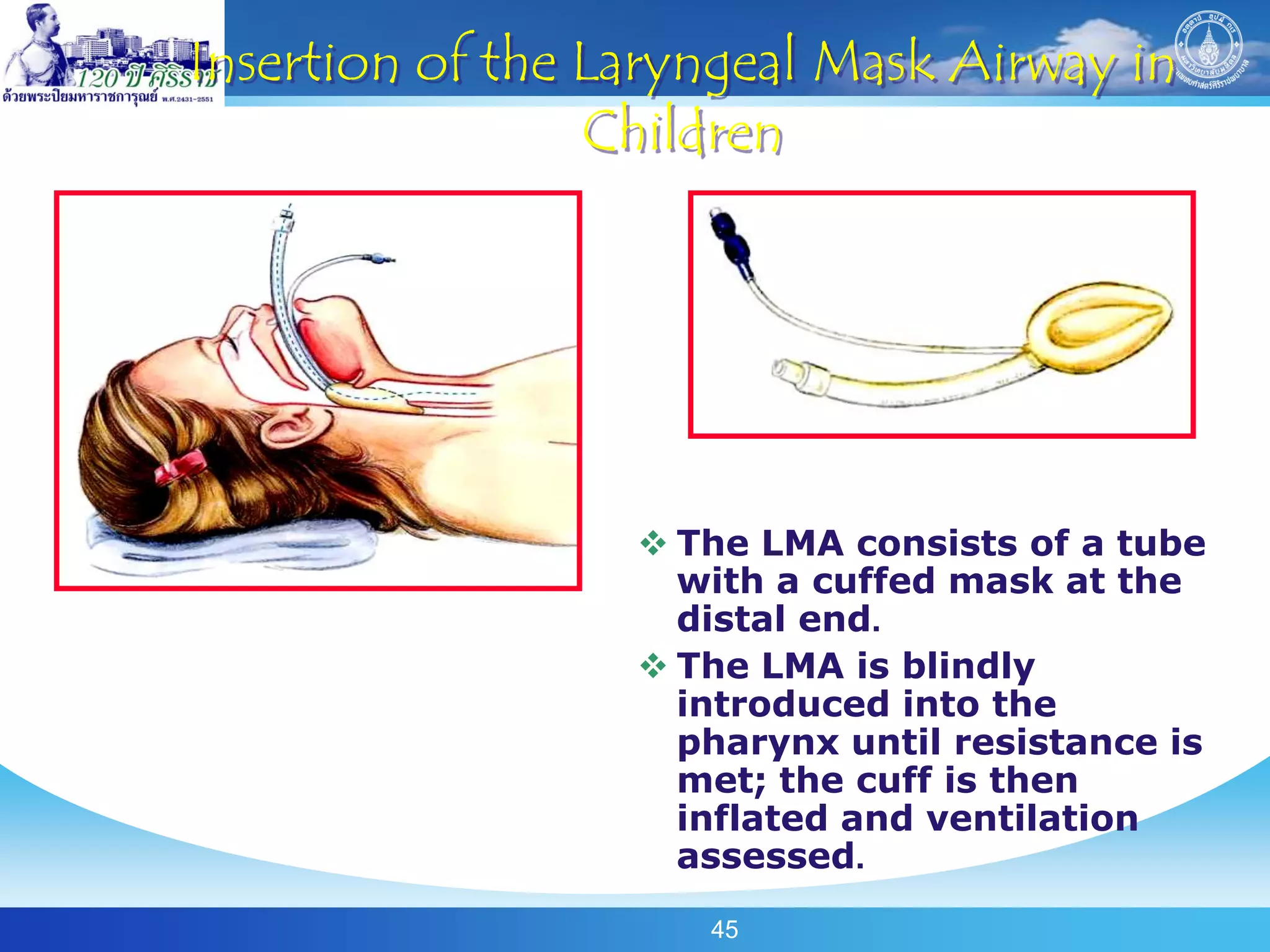 Insertion of the Laryngeal Mask Airway in
                 Children




                   The LMA consists of a tube
                    with a cuffed mask at the
                    distal end.
                   The LMA is blindly
                    introduced into the
                    pharynx until resistance is
                    met; the cuff is then
                    inflated and ventilation
                    assessed.
                     45
 