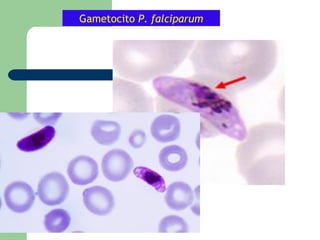 Gametocito P. falciparum
 