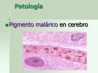 Patología
Pigmento malárico en cerebro
 