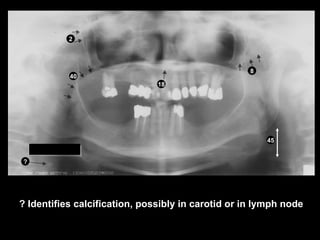 panoramic radiographic landmarks in dentistry | PPT