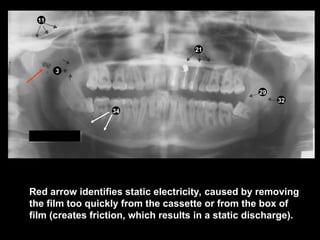 panoramic radiographic landmarks in dentistry | PPT