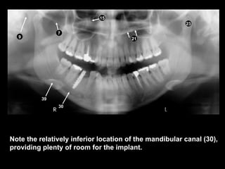 panoramic radiographic landmarks in dentistry | PPT