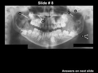 panoramic radiographic landmarks in dentistry | PPT