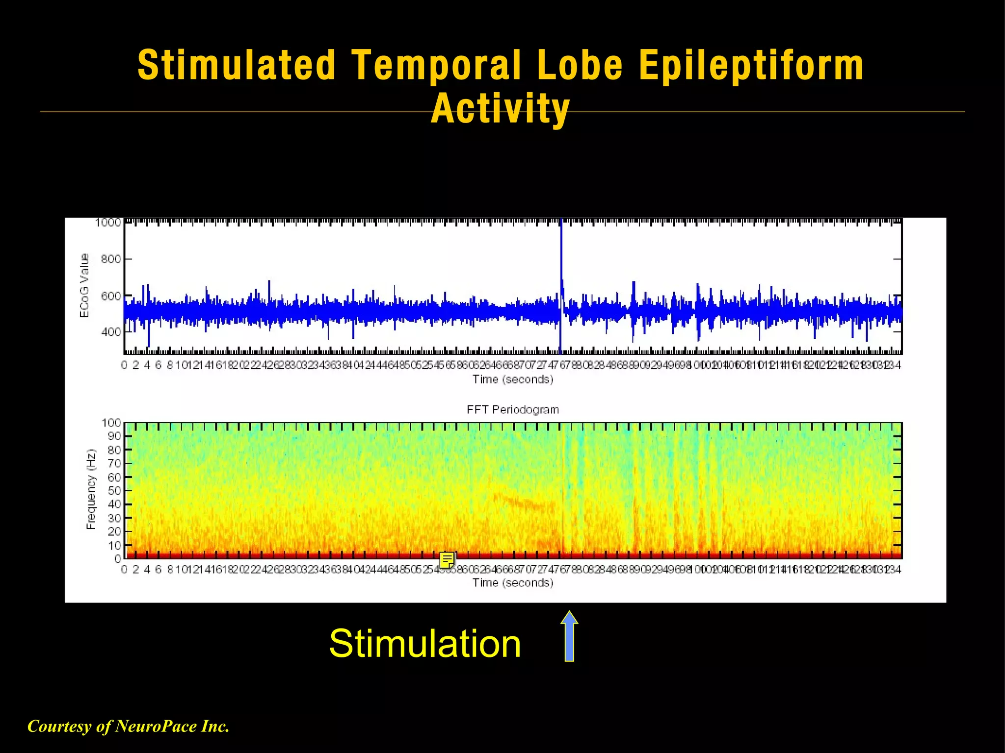 Stimulated Temporal Lobe Epileptiform Activity Stimulation Courtesy of NeuroPace Inc. 