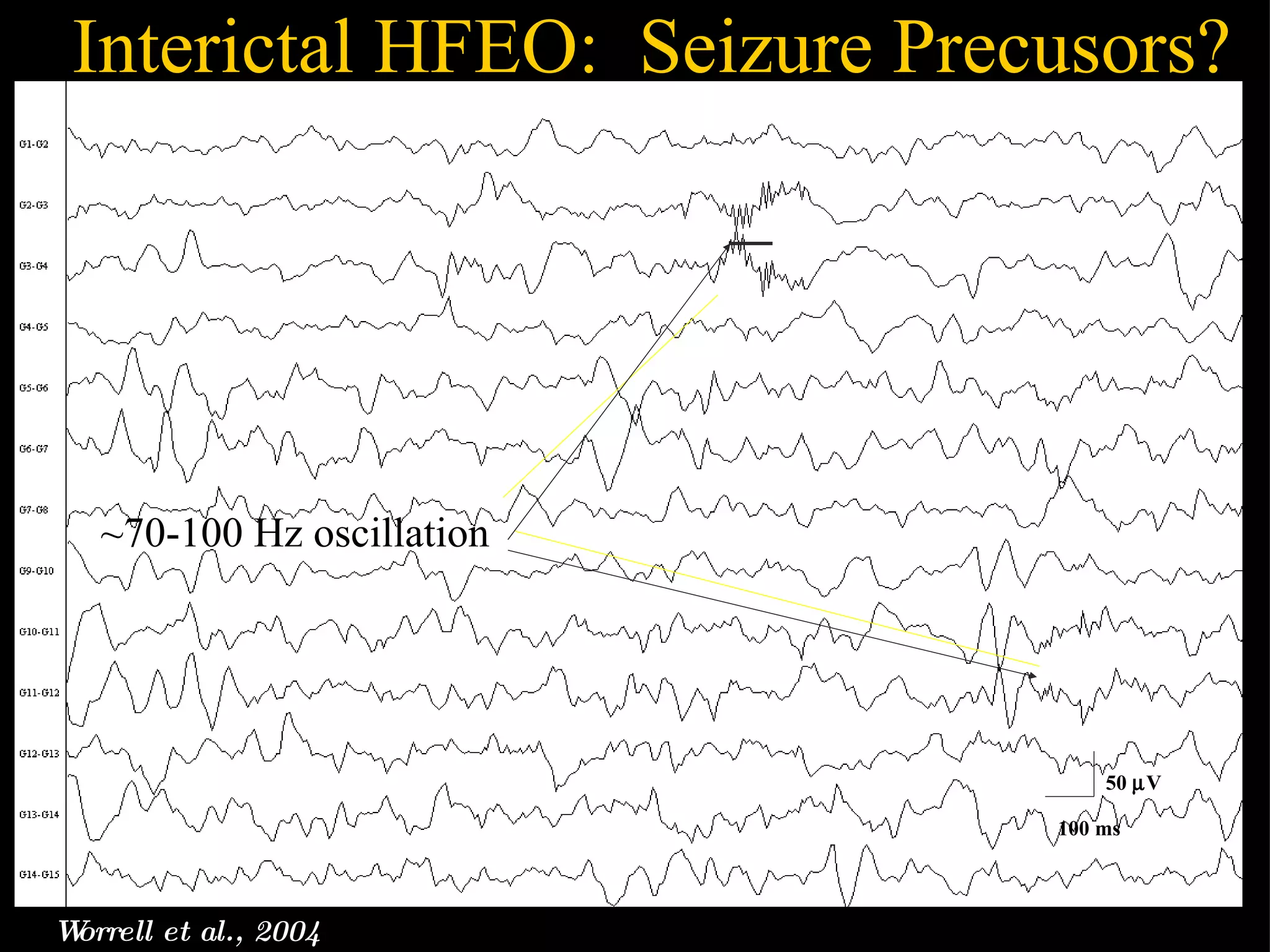 Interictal HFEO:  Seizure Precusors? Worrell et al., 2004 50   V 100 ms ~70-100 Hz oscillation 