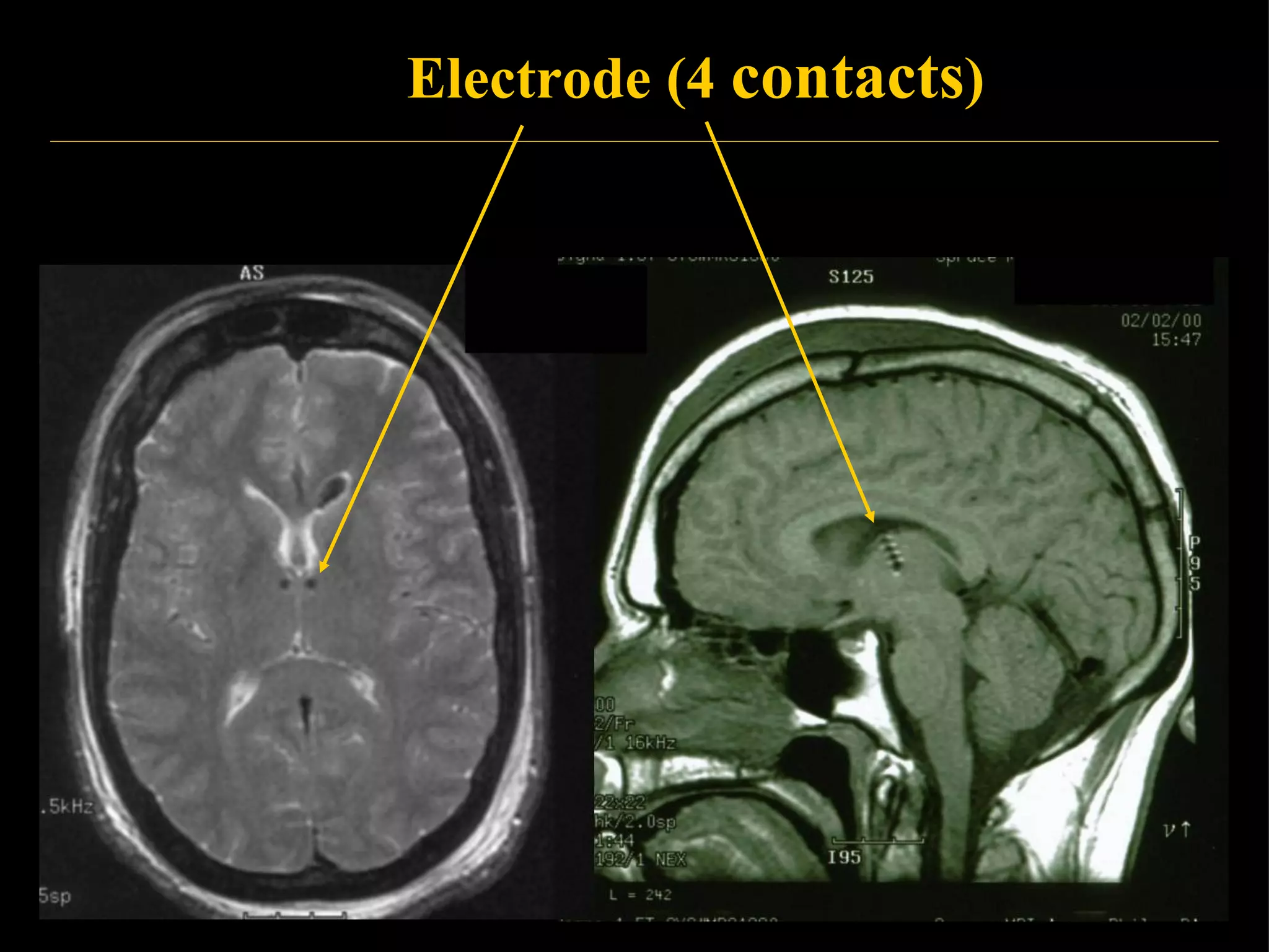 Stimulating Electrode, 4 contacts Electrode (4  contacts ) 