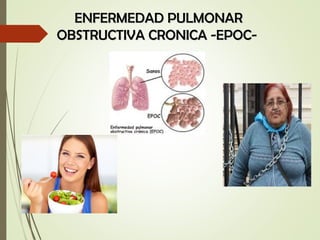 ENFERMEDAD PULMONARENFERMEDAD PULMONAR
OBSTRUCTIVA CRONICA -EPOC-OBSTRUCTIVA CRONICA -EPOC-
 