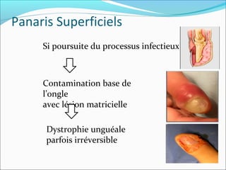Panaris Superficiels
Si poursuite du processus infectieux
Contamination base de
l’ongle
avec lésion matricielle
Dystrophie unguéale
parfois irréversible
 