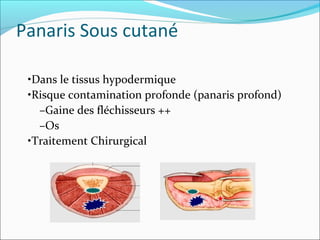 Panaris Sous cutané
•Dans le tissus hypodermique
•Risque contamination profonde (panaris profond)
–Gaine des fléchisseurs ++
–Os
•Traitement Chirurgical
 