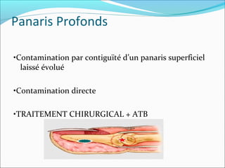 Panaris Profonds
•Contamination par contiguïté d’un panaris superficiel
laissé évolué
•Contamination directe
•TRAITEMENT CHIRURGICAL + ATB
 