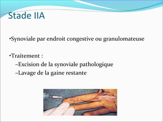 Stade IIA
•Synoviale par endroit congestive ou granulomateuse
•Traitement :
–Excision de la synoviale pathologique
–Lavage de la gaine restante
 