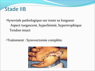 Stade IIB
•Synoviale pathologique sur toute sa longueur
Aspect turgescent, hyperhémié, hypertrophique
Tendon intact
•Traitement : Synovectomie complète
 
