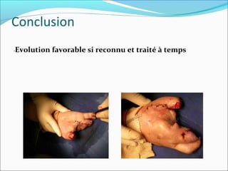 Conclusion
•Evolution favorable si reconnu et traité à temps
 