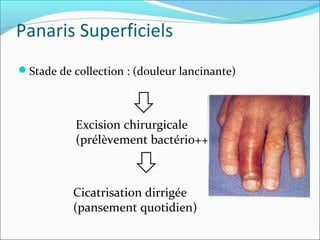 Panaris Superficiels
Stade de collection : (douleur lancinante)
Excision chirurgicale
(prélèvement bactério++)
Cicatrisation dirrigée
(pansement quotidien)
 