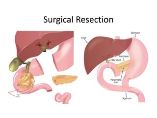 Pancreatic Cysts: A Contemporary Approach | PDF